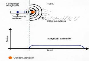 Ударно волновая терапия: Акустическая волна Ударно волновая терапия