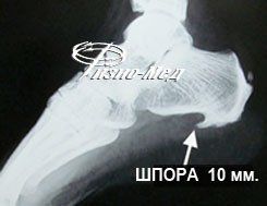 Пяточная шпора фото 2 пяточная шпора фото 2