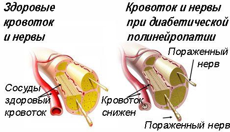 Диабетическая полинейропатия