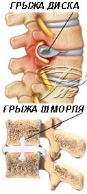 Грыжа Шморля