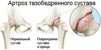 sfătuiți unguent pentru durere în articulațiile genunchiului tratamentul articulațiilor strâmte