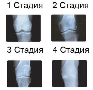 stages of knee
