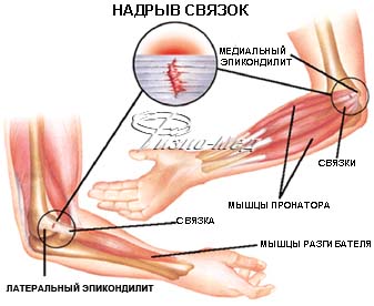 Эпикондилит лечение