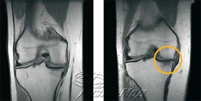 Акции мрт. Липоматоз коленного сустава мрт. Мрт суставов вологда. Мрт акции скидки. Лигаментоз коленного сустава мрт.