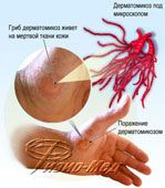 инфекционные заболевания