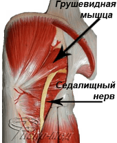 Синдром грушевидной мышцы