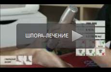 Пяточная шпора лечение